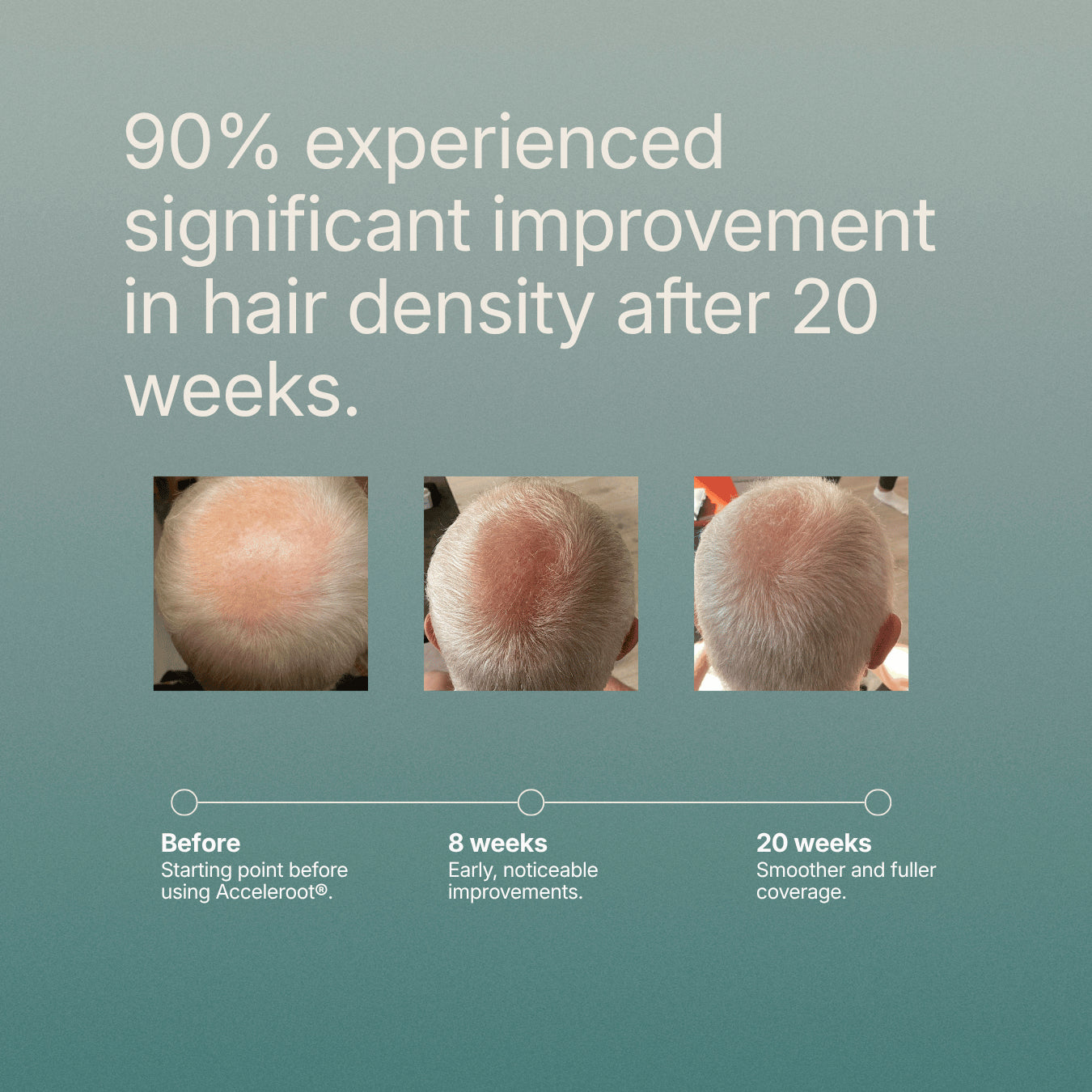 Acceleroot® Hair Growth Oil